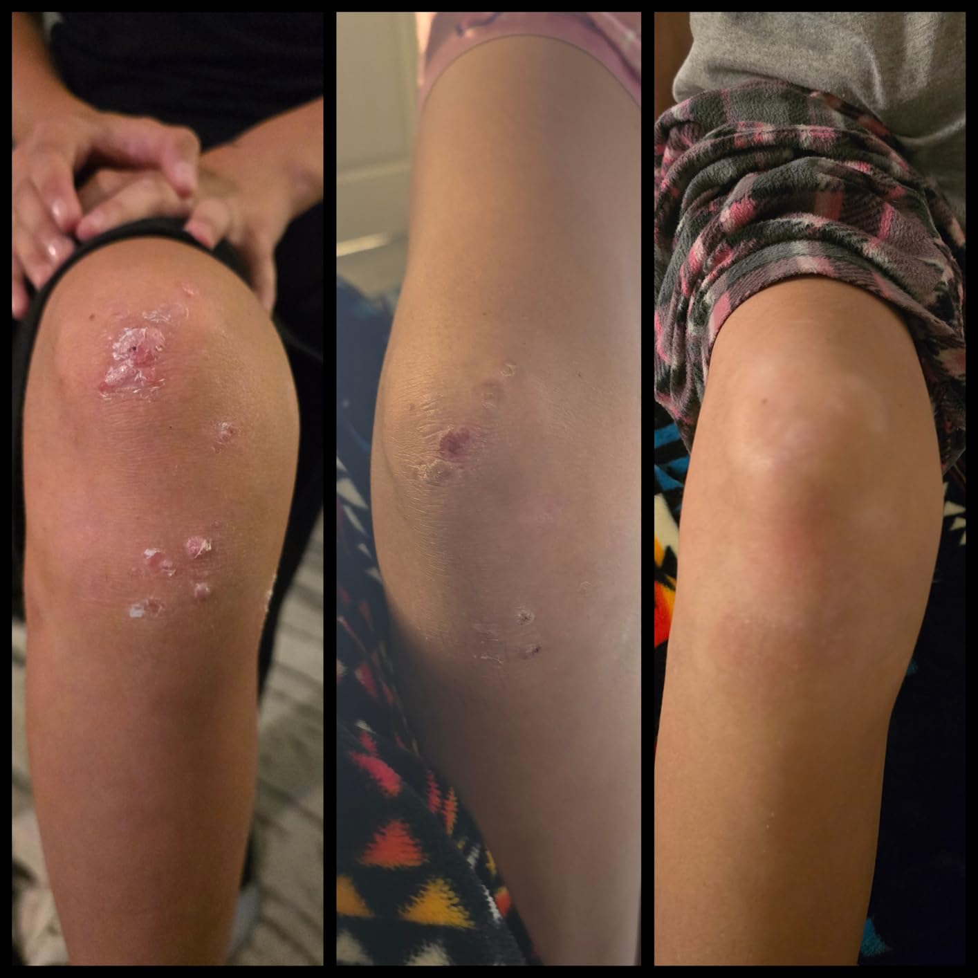 Bee Venom Wart Removal Kit™