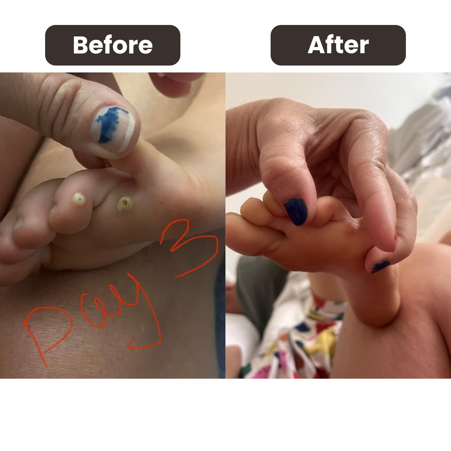 Bee Venom Wart Removal Kit™