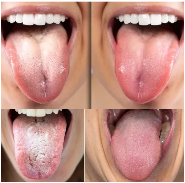Candida Cleanse: White Tongue Detox Kit™