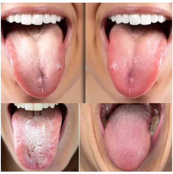 Candida Cleanse: White Tongue Detox Kit™