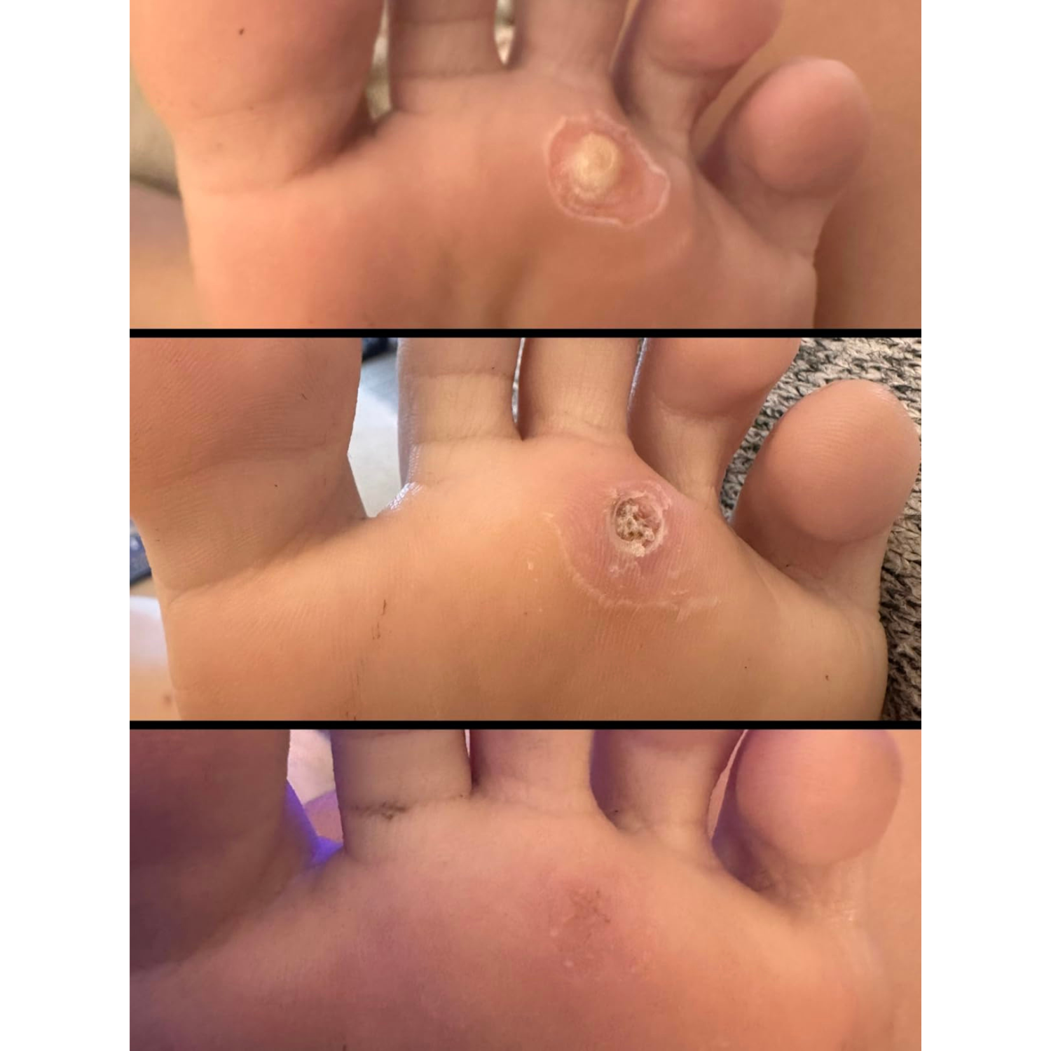 Bee Venom Wart Removal Kit™