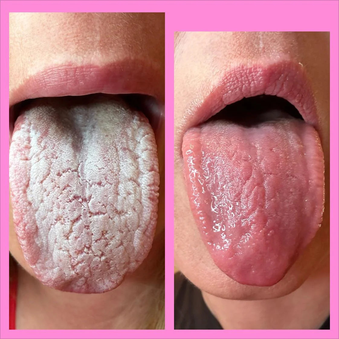 Candida Cleanse: White Tongue Detox Kit™